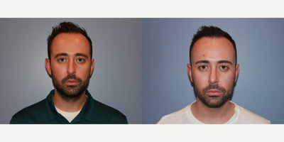 18-24 year old man treated with Chin Implant - Man treated with Chin Implant