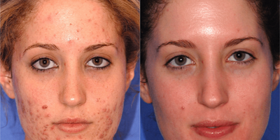18-24 year old woman treated with Smoothbeam Laser - Patient was treated with medical skin care, Smoothbeam, IPL, and Blue Peel.