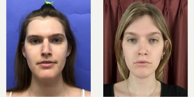 Patient treated with Adam's Apple Reduction, Forehead Reduction, Brow Lift, Facial Fat Transfer - 25 to 34 year-old female patient is 1 year post-op from Facial Feminization surgery. Her procedures included:Forehead Lift, Hairline Lowering, Superorbital Bone Reduction and ContouringSeptorhinoplasty (closed) with Cartilage Grafts and WeirsChin Reduction and ContourThyroid Cartilage ShaveVoice FeminizationFat Augmentation to Lips