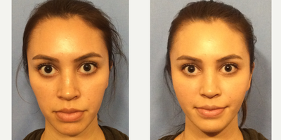 25-34 year old woman treated with Injectable Fillers - Young female receiving Revanesse Versa filler in temples, malar pads and tear troughs using an advanced technique - blending product using cannulas and needles. No bruising or downtime. After photo is immediately following procedure. Pt was very satisfied.