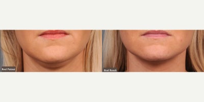 Woman treated with Chin Liposuction - Woman treated with Chin/Neck Liposuction