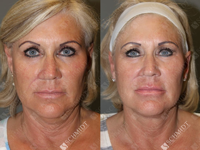 Woman treated with Revision Rhinoplasty - We performed revision rhinoplasty to produce a more desirable shape,and this also significantly improved her nasal breathing. She felt that the external portion nostril was too big and the bottom edge of this tissue was too flat relative to the other side. If you look at the post-operative photos, youll notice that the curved contour of the bottom edge of the nostril on the right more closely matches the untreated left side.