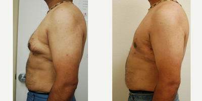 35-44 year old man treated with Male Breast Reduction - This gentleman in his late 30s presented with gynecomastia. It is abnormal growth of breast tissue in men and is much more common than most people think. He had an ultrasound assisted liposuction and excision of the gynecomastia through a lateral liposuction port site. No incisions were made around the nipple or areola. These pictures are taken in the early recovery period.