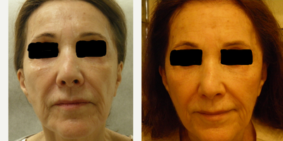 75 and up year old woman treated with Vampire Facelift - 80 yo female after VAmpire Facelift for eyelids and mid face.