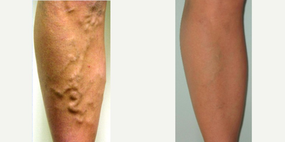 35-44 year old woman treated with EVLT - Endovenous laser therapy is a quick, minimally invasive laser procedure that leaves no scar, has a short post-operative recovery period with only mild discomfort and is performed under local anesthesia.  The area of the leg to be treated is anesthetized locally and a thin laser fiber is inserted into the abnormal vein, delivering the laser energy in short pulses. The laser energy heats the vein causing it to shrink and collapse, preventing blood from pooling.  With the Ambulatory phlebectomy, there is the removal of large surface varicosities through very small incisions that frequently need no stitches.  Both procedures have rapid recovery with reduced post-operative pain. Normal activities can be resumed immediately and patients have excellent clinical and aesthetic results.