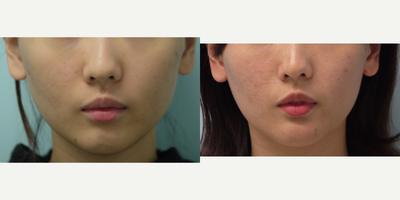 25 year old woman treated with Jawline Contouring - 25-year-old with jawline contouring