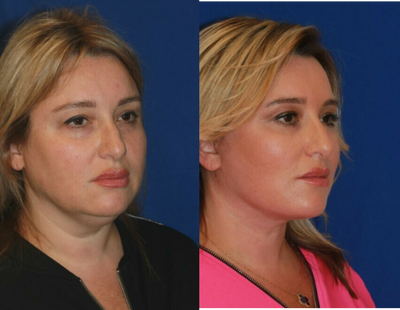 45-54 year old woman treated with Facelift - A Face and Neck lift surgery for the female patient in her 50s helped to achieve beautiful lower face and neck contours, get rid of the skin laxity in the lower face area and fullness under he chin. These excellent rejuvenation boosted patient's confidence and self-esteem!