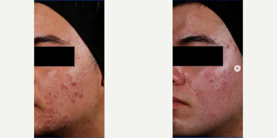Man treated with AviClear - ince acne occurs when there is an overproduction of sebum in the sebaceous glands, this innovative device selectively targets the sebocytes by suppressing these glands in order to reduce active acne, and lessen the intensity and frequency of future breakout episodes. All without the need of prescription, chemicals, labs, or downtime. #aviclear AviClear is able to deliver not just acne clearance, but overall healthier skin in just 3 sessions!