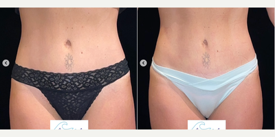 Woman treated with truSculpt, truFlex - Woman treated with truSculpt, truFlex