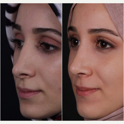 25-34 year old woman treated with Revision Rhinoplasty - woman treated with Revision Rhinoplasty