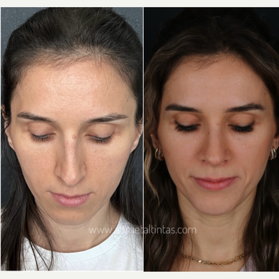 25-34 year old woman treated with Rhinoplasty - woman treated with Rhinoplasty