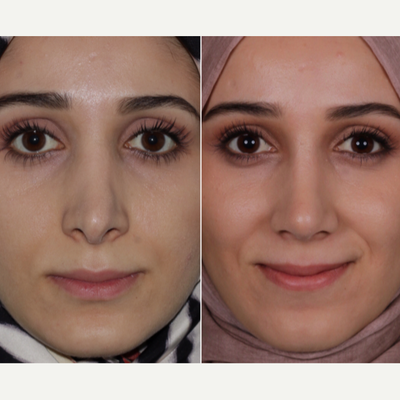 25-34 year old woman treated with Revision Rhinoplasty - woman treated with Revision Rhinoplasty