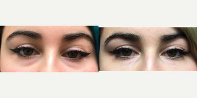 18-24 year old woman treated with Injectable Fillers - Restylane Silk injection under the eyes to eliminate bags.