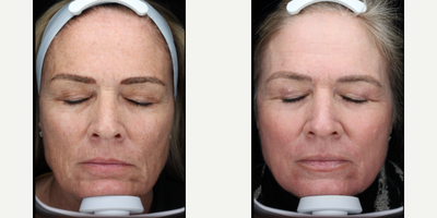 25-34 year old woman treated with Scar Removal, Laser Scar Removal - Patient had Profractional around her eyes to treat sebaceous hyperplasia