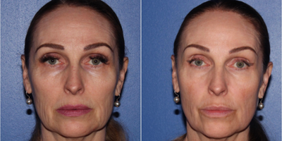 55-64 year old woman treated with Scar Removal, Laser Scar Removal - Patient was treated with Profractional full face and 1 follow up Clear and brilliant 5 months later