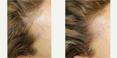 55-64 year old woman treated with PRF Treatment - 55-64 year old woman treated with PRF Treatment for hair loss