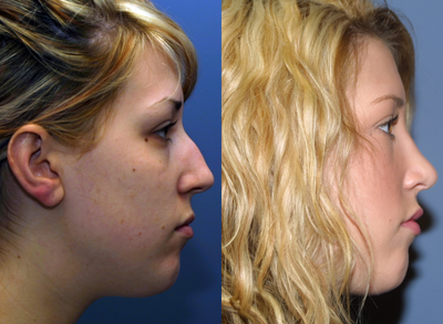 Woman treated with Rhinoplasty - Woman treated with Rhinoplasty