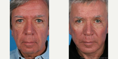 Man treated with Cheek Implants - Man treated with Cheek Implants