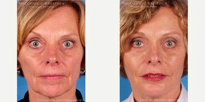 Woman treated with Cheek Implants - Woman treated with Cheek Implants