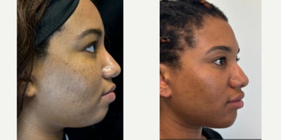 18-24 year old woman treated with Morpheus8, Microneedling RF - Treated by Alyssa Gutierrez