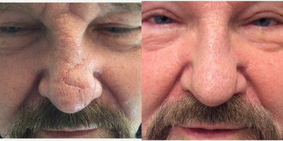 45-54 year old man treated with Fraxel Repair - Before and 7 months after Fractional Repair (CO2) laser resurfacing of Mohs scar.