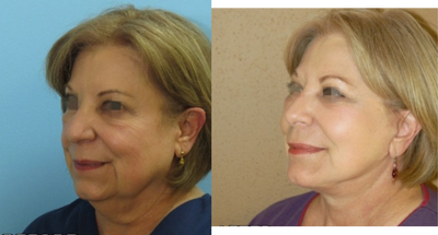 55-64 year old woman treated with Facelift - Full face and neck lift and midface lift.