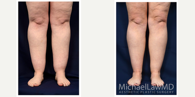 25-34 year old woman treated with Calf Reduction - Lower leg liposcution