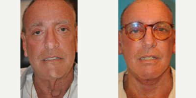 Man treated with SMAS Facelift - Man treated with Deep Plane Facelift, SMAS Facelift, and the subcuticular plane. Eyelid Surgery was also performed. Patient is shown before and 1 week post-op.
