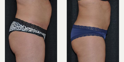 45-54 year old woman treated with truSculpt - Treatment areas: abdomen, waist, inner thighsNumber of treatments: 153 years old, 5'8 tall, 166 lbFat pinch thickness: each area decreased at least 25% after treatment