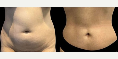 Woman treated with Liposuction - Woman treated with Liposuction