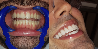 25-34 year old man treated with Durathin Veneers - we performed a smile makeover procedure with high quality matrices, the patient wanted a beautiful and elegant smile.