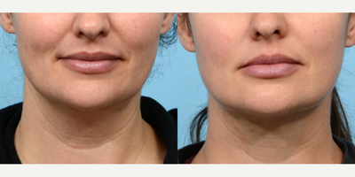 35-44 year old woman treated with Chin Liposuction - Dr. Wise performed Submental Liposuction on this 44-year-old patient who was looking to remove excess submental and jowl fat. 2 months post-op, she is thrilled about her defined and contoured facial profile.