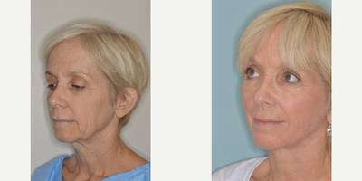 55-64 year old woman treated with Laser Resurfacing - Before and After Facelift and Laser resurfacing