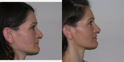 25-34 year old woman treated with Rhinoplasty - Patient had a primary rhinoplasty years earlier and wanted further elevation and definition of the tip and dorsum. This is a secondary rhinoplasty, open technique shown before and six weeks after surgery. Patient continues to heal and massage. All procedures done by Frank J. Ferraro, MD.