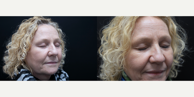 45-54 year old woman treated with Thermage, Thermage FLX - 45-54 year old woman treated with Thermage, Thermage FLX, focusing on the eye and undereye area