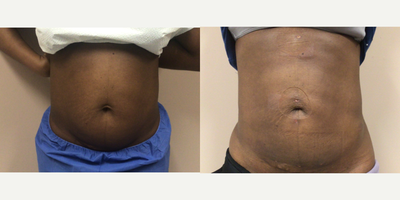 25-34 year old man treated with Laser Liposuction, Tickle Lipo - One week Post Op Time.