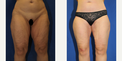55-64 year old woman treated with Thigh Lift - This is a 55 year old White female patient who is 55.5 who weighed 240 pounds.  She currently weighs 160 pounds.  After weight loss, she was not happy with the excess skin and fat in her inner thighs.  She underwent a medial thigh lift with Dr. J. Timothy Katzen in Beverly Hills, CA.  Notice how her thighs are smaller and smoother now.  Shes pleased with her thigh lift results.