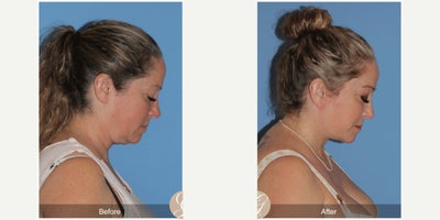 45-54 year old woman treated with Deep Plane Facelift, Neck Lift, Brow Lift, CO2 Laser, MACS Facelift - 52 year old treated with Deep Plane Face and Neck Lift, Temporal Brow Lift, CO2 Laser of Face, MAC