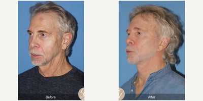 69 year old man treated with Lower Facelift, Neck Lift, Xeomin, PRP Injections - 69 year old man treated with Lower Face and Necklift, Fat Grafting with PRP to Malar and Forehead, Xeomin to Forehead