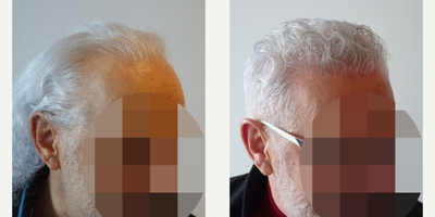 55-64 year old man treated with FUE Hair Transplant - 1023 grafts - 1 hair (1023) 1210 grafts - 2 hair (2420) 967 grafts - 3 hair (2901)
In total : 3200 grafts - 6344 hair