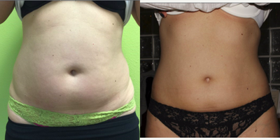 45-54 year old woman treated with Vanquish - This patient is a 46 year old mother of 2, treated with 6 sessions of Vanquish ME.
