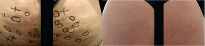 45-54 year old woman treated with Cellfina - Extraordinary Service. Stunning Results.The before photo shows the mark-up process where we place X's & O's to indicate unwanted dimples before your Cellfina treatment. The stunning after results show only 1 treatment of Cellfina