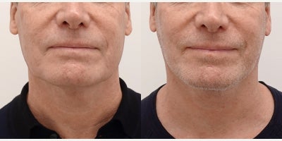 45-54 year old man treated with Facelift, MACS Facelift - This male patient received a MACS Facelift by Dr. Charles K Lee in San Francisco at L Plastic Surgery in 2024. This patient is thrilled with their natural results, turning back the clock 10 years with their new tightened and youthful face. Dr. Lee's expertise is demonstrated through this artful transformation.