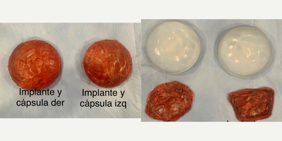 45-54 year old woman treated with Breast Implant Removal, Enbloc capsulectomy, Capsular Contracture Treatment - Female patient with breast implant illnes (BII) and Asia syndrome, she had an Enbloc capsulectomy after her breast lift and breast augmentation surgery. She underwent for a total Capsulectomy surgery with an Enbloc surgery technique. You can see the total capsule removal with her implants inside the capsule. After her surgery all her symptoms disappeared.