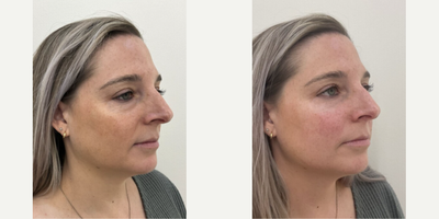 35-44 year old woman treated with Restylane, Restylane Lyft - Under eye filler