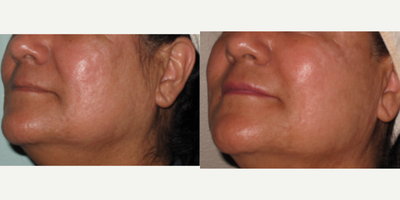 35-44 year old woman treated with Pixel Laser - Pixel Perfect Laser to acne scarring of female 35-44 years old