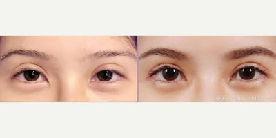 Woman treated with Double Eyelid Surgery - Woman treated with Double Eyelid Surgery
