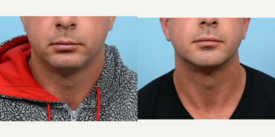 35-44 year old man treated with Chin Implant - In order to achieve the chiseled jawline of this patient's dreams, Dr. Wise performed a combination of chin implant and submental liposuction procedures.