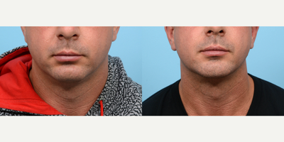 35-44 year old man treated with Chin Implant - In order to achieve the chiseled jawline of this patient's dreams, Dr. Wise performed a combination of chin implant and submental liposuction procedures.
