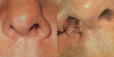 45-54 year old man treated with Alarplasty - External flap used to widen a nostril which contracted following radiation therapy.